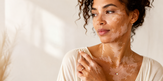Femme avec vitiligo portant un bijou personnalisé pierre de naissance Vanityl, symbole de lien, de souvenir et d’amour durable.