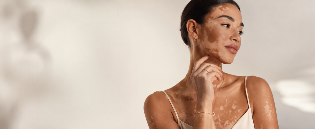 Femme élégante atteinte de vitiligo portant des bijoux fins, photographiée dans une lumière douce sur un fond épuré, dans une ambiance premium et apaisée.