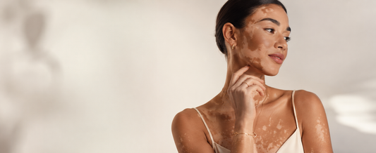 Femme élégante atteinte de vitiligo portant des bijoux fins, photographiée dans une lumière douce sur un fond épuré, dans une ambiance premium et apaisée.
